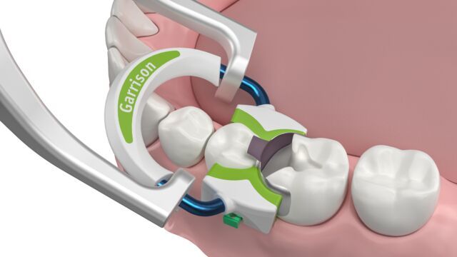 Strata-G by Garrison Dental